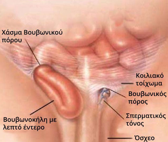 vouvonokil6