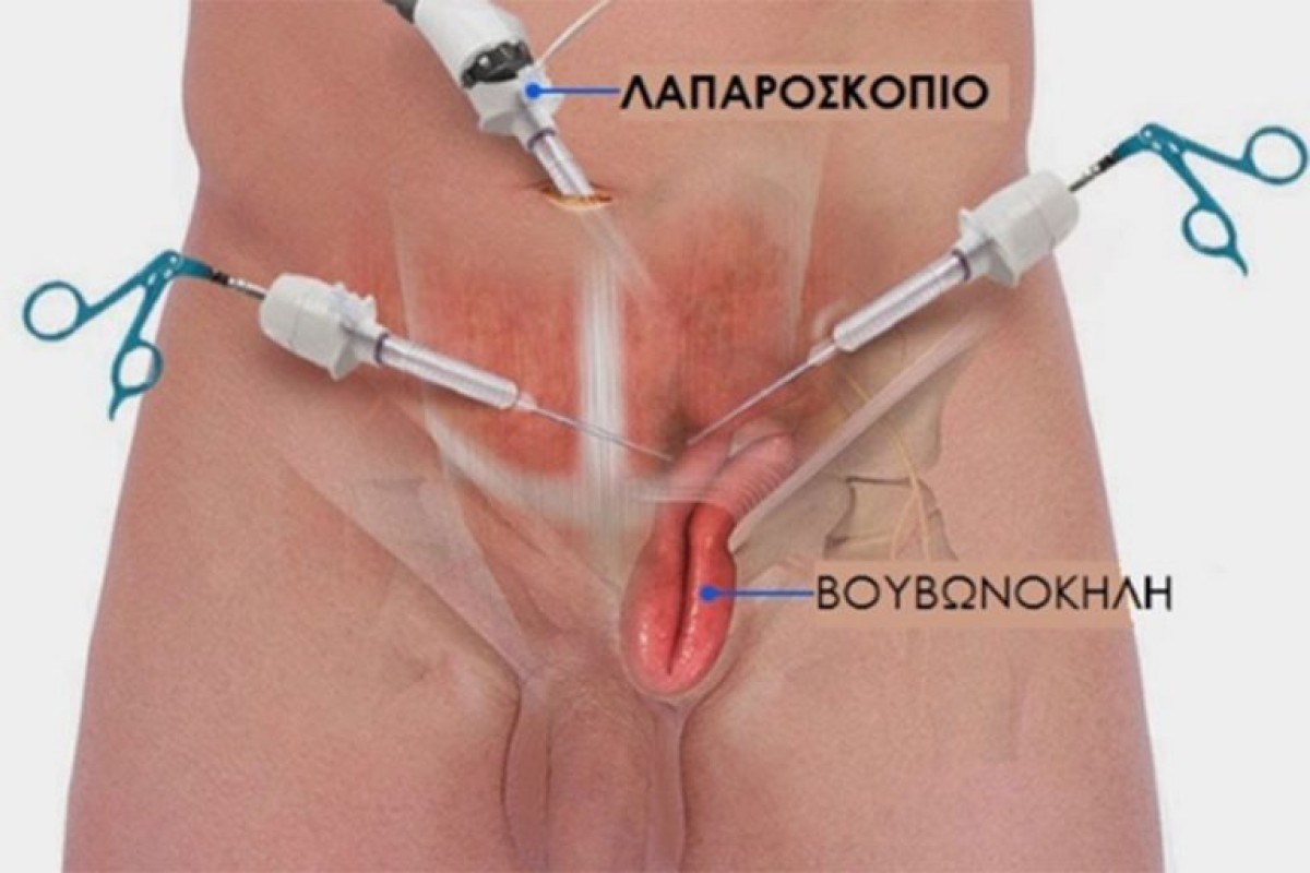 Βουβωνοκήλη: τι είναι και πώς αντιμετωπίζεται με ασφάλεια!