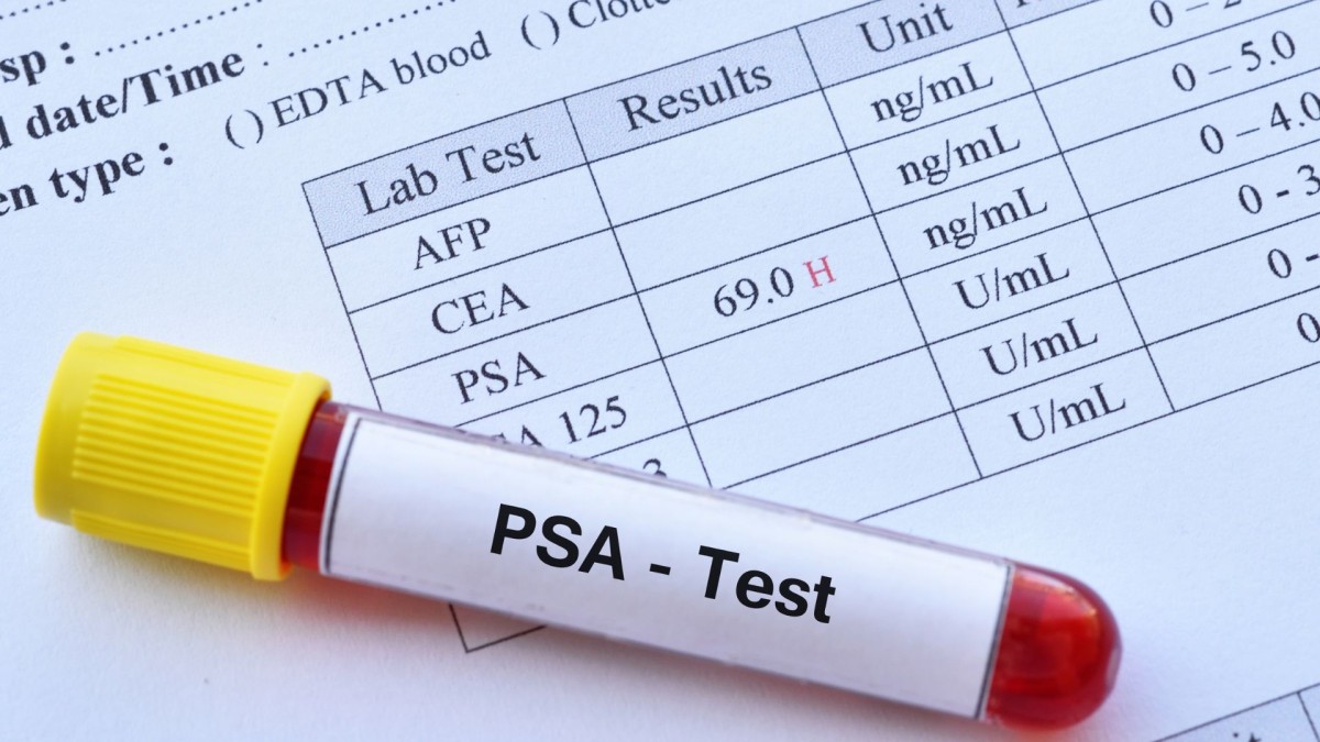 Η σημασία της εξέτασης PSA στην πρόληψη του καρκίνου του προστάτη